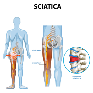 Non-Surgical Treatment for Sciatica
